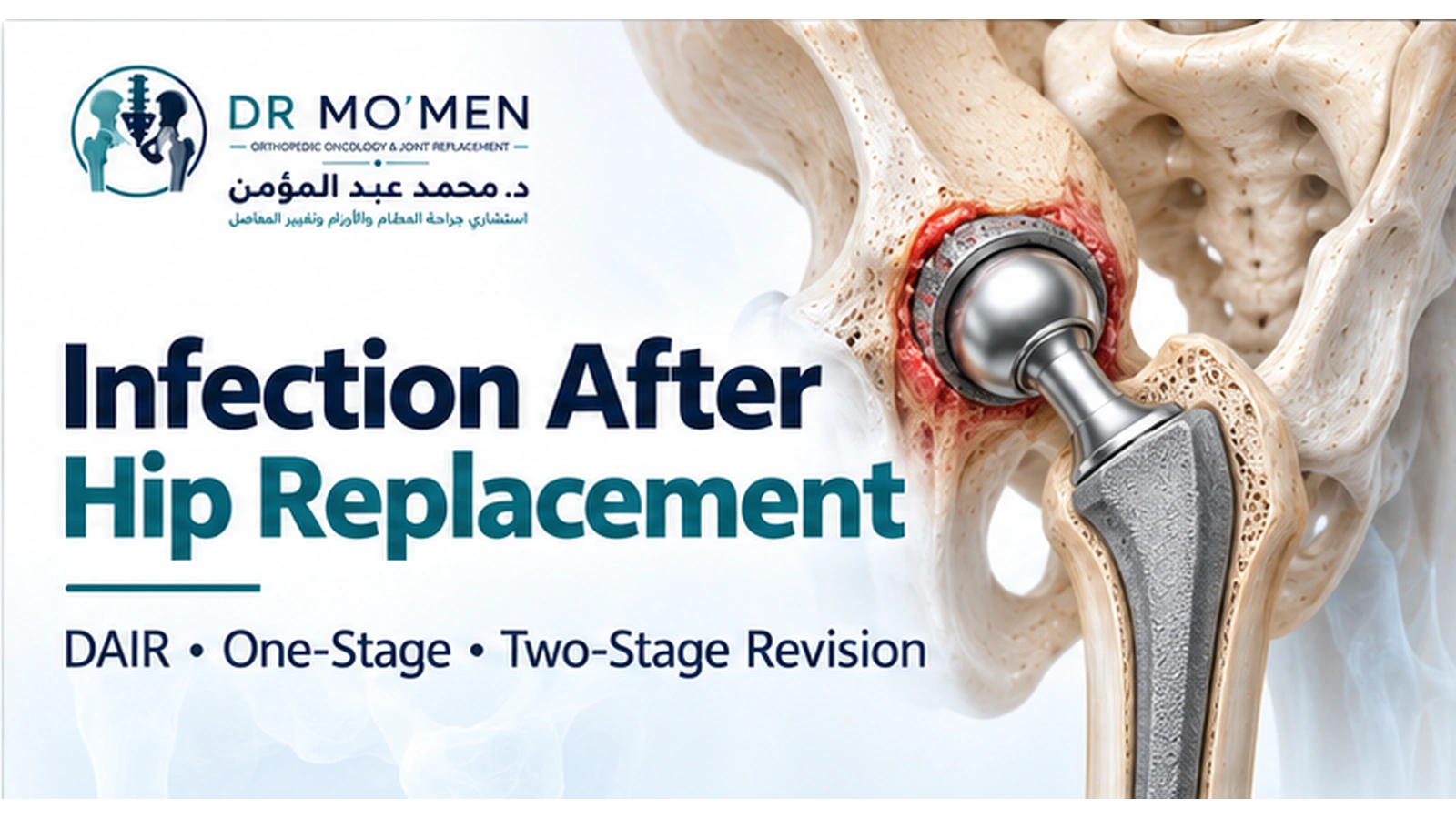 Infection After Hip Replacement 3D medical illustration of an infected total hip replacement showing prosthetic joint infection and revision treatment planning.