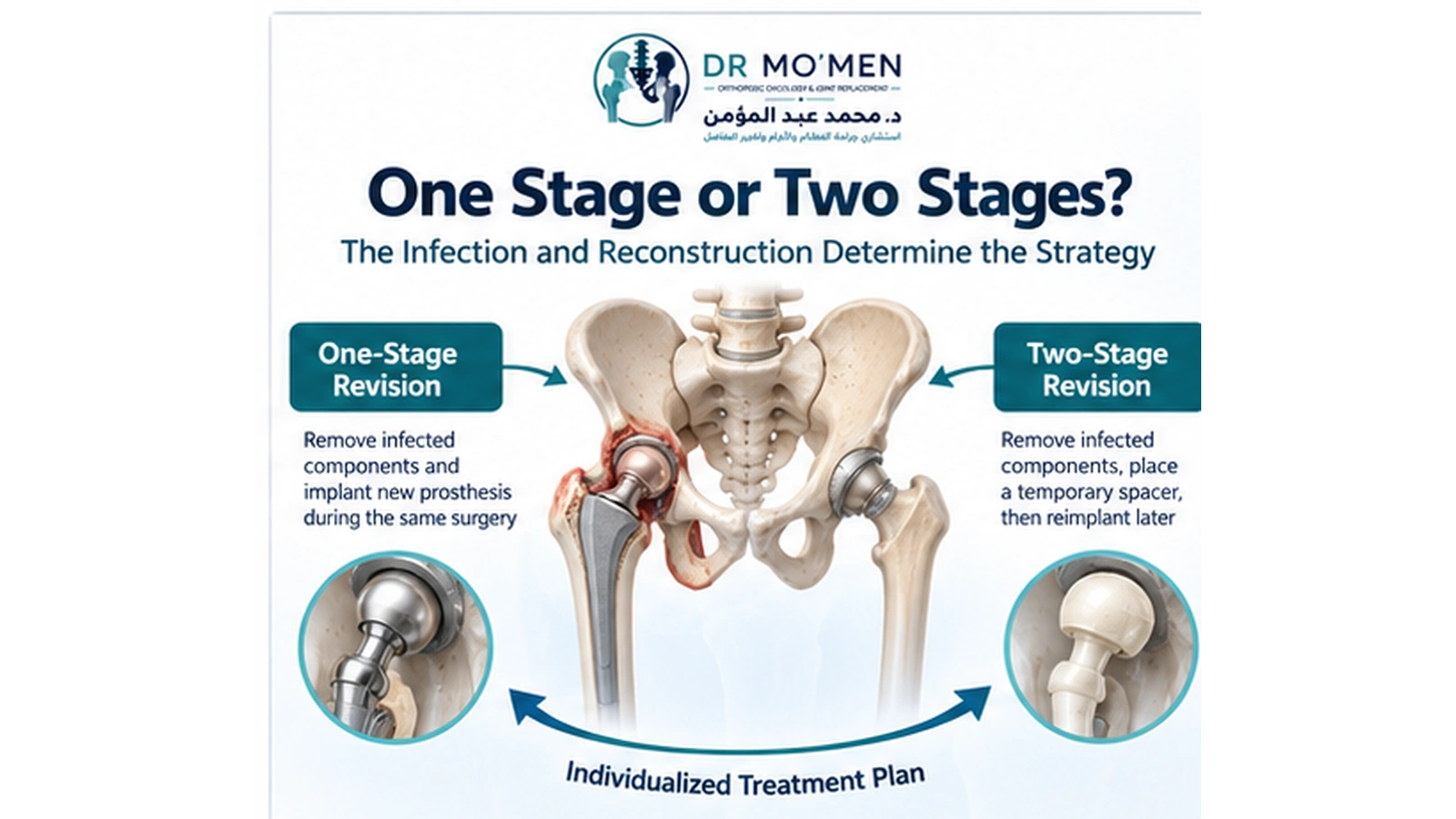 One Stage or Two Stages? Medical illustration explaining surgical planning for one-stage and two-stage revision of an infected hip replacement.