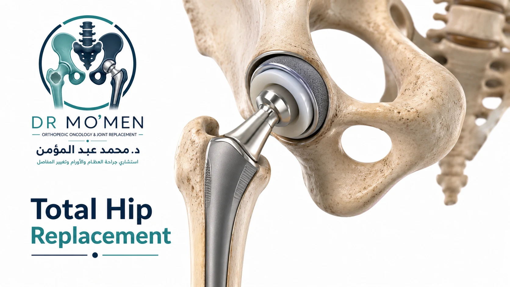 3D medical illustration showing the components of a total hip replacement