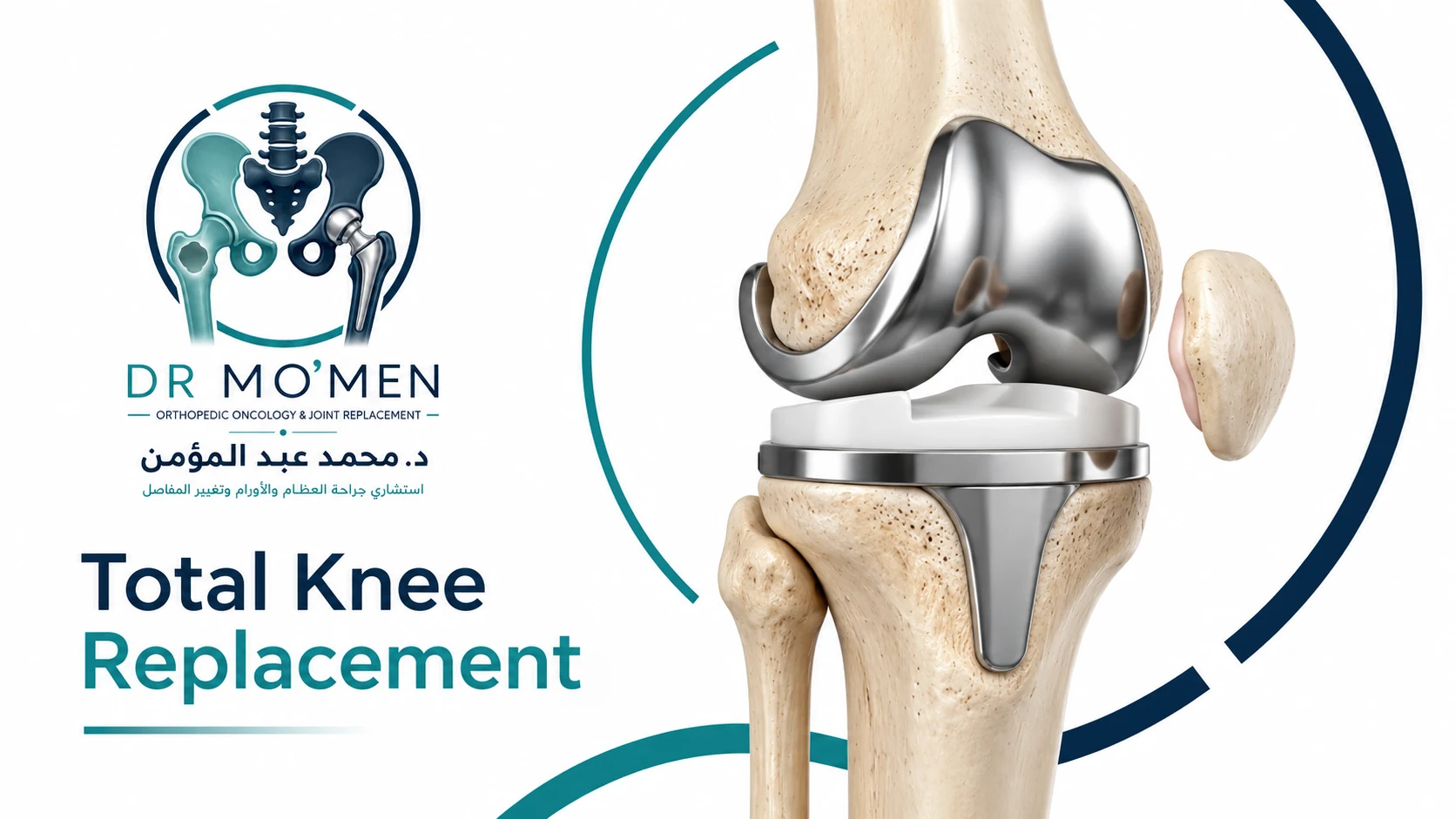 3D illustration of a total knee replacement showing femoral, tibial and polyethylene components
