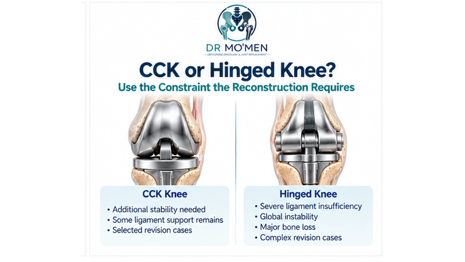CCK or Hinged Knee? Educational 3D illustration explaining CCK versus hinged knee constraint in revision surgery.