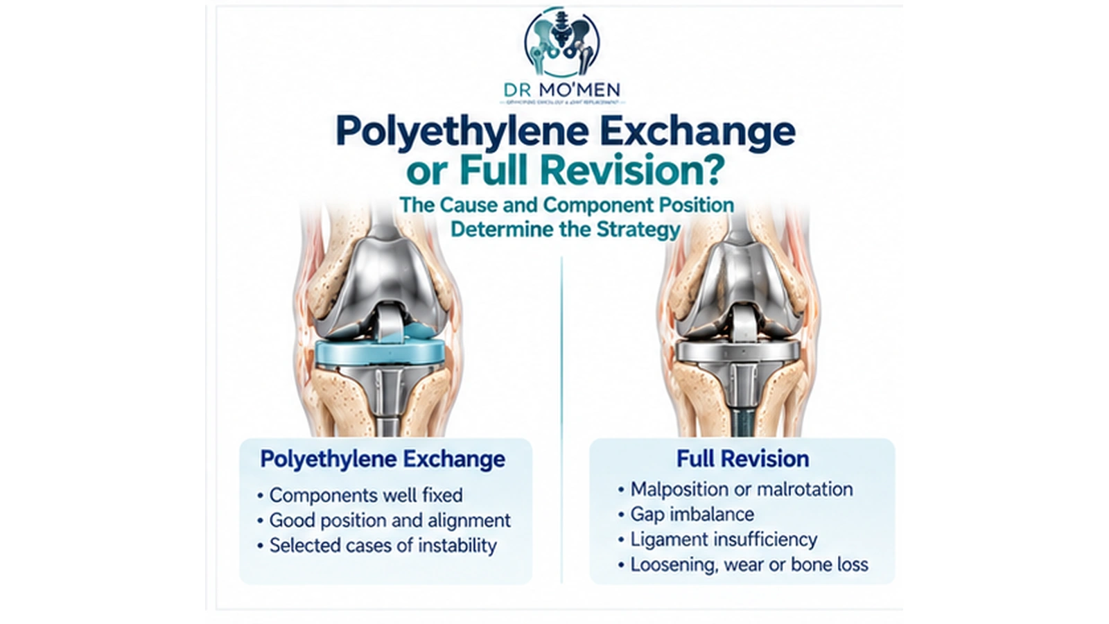 Polyethylene Exchange or Full Revision? 3D medical illustration comparing selected polyethylene insert exchange with full revision knee replacement.