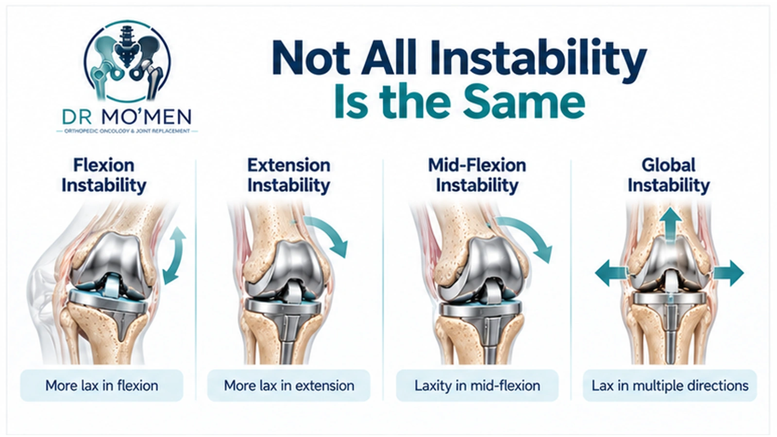 Not All Instability Is the Same Medical infographic showing flexion, extension, mid-flexion and global instability after knee replacement.
