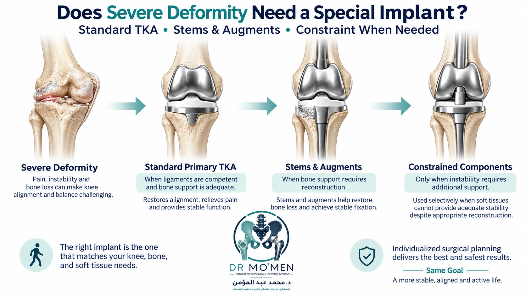 Does Severe Deformity Need a Special Implant? Medical illustration showing standard total knee replacement, stems and augments, and constrained components for severe knee deformity when needed.