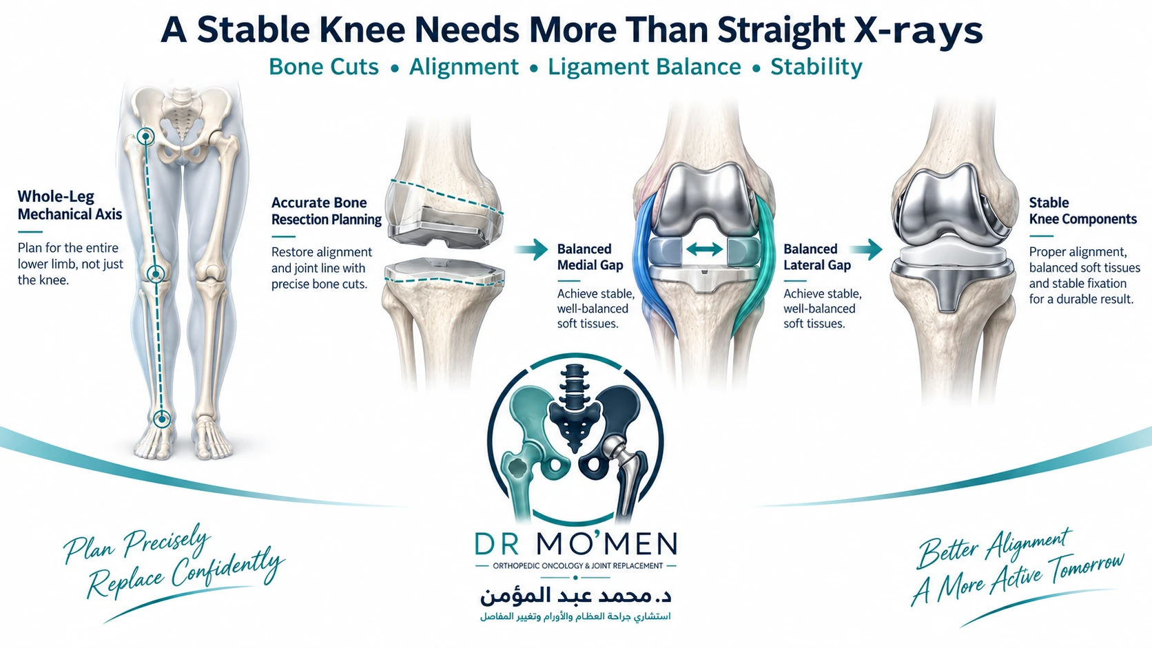 A Stable Knee Needs More Than Straight X-rays Medical infographic showing whole-leg alignment, bone cuts, ligament balance and stability in complex knee replacement.
