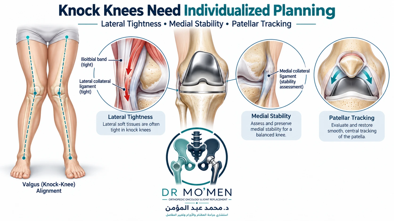 Knock Knees Need Individualized Planning Medical infographic showing valgus knock-knee deformity with lateral tightness, medial ligament assessment and patellar tracking.
