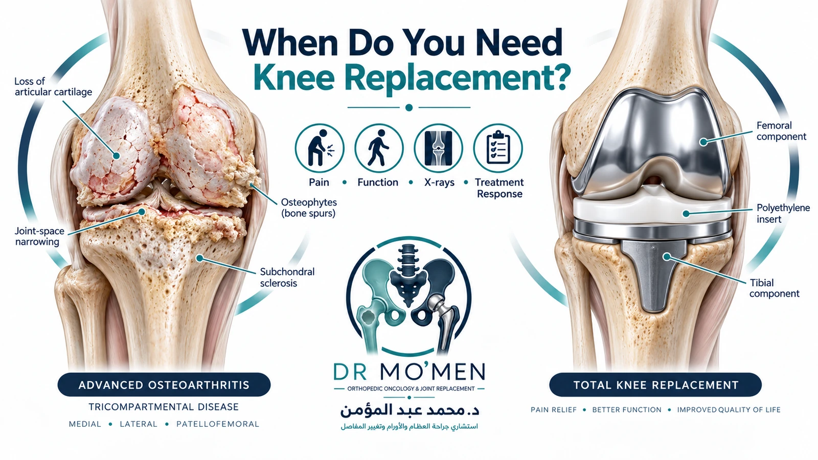 When Do You Need Knee Replacement? Medical illustration showing advanced knee osteoarthritis beside a total knee replacement and the factors used to decide when surgery may be appropriate.
