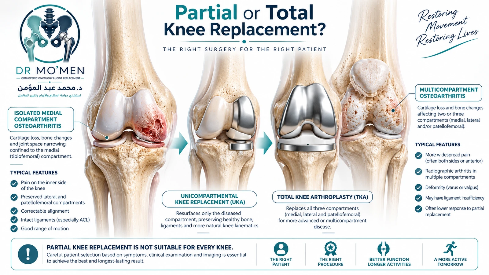 Partial or Total Knee Replacement? Anatomically accurate medical illustration explaining selection between partial and total knee replacement according to the distribution of knee arthritis.