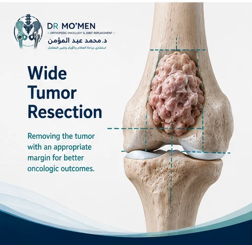 3D medical illustration showing planned wide resection around a distal femoral bone tumor
