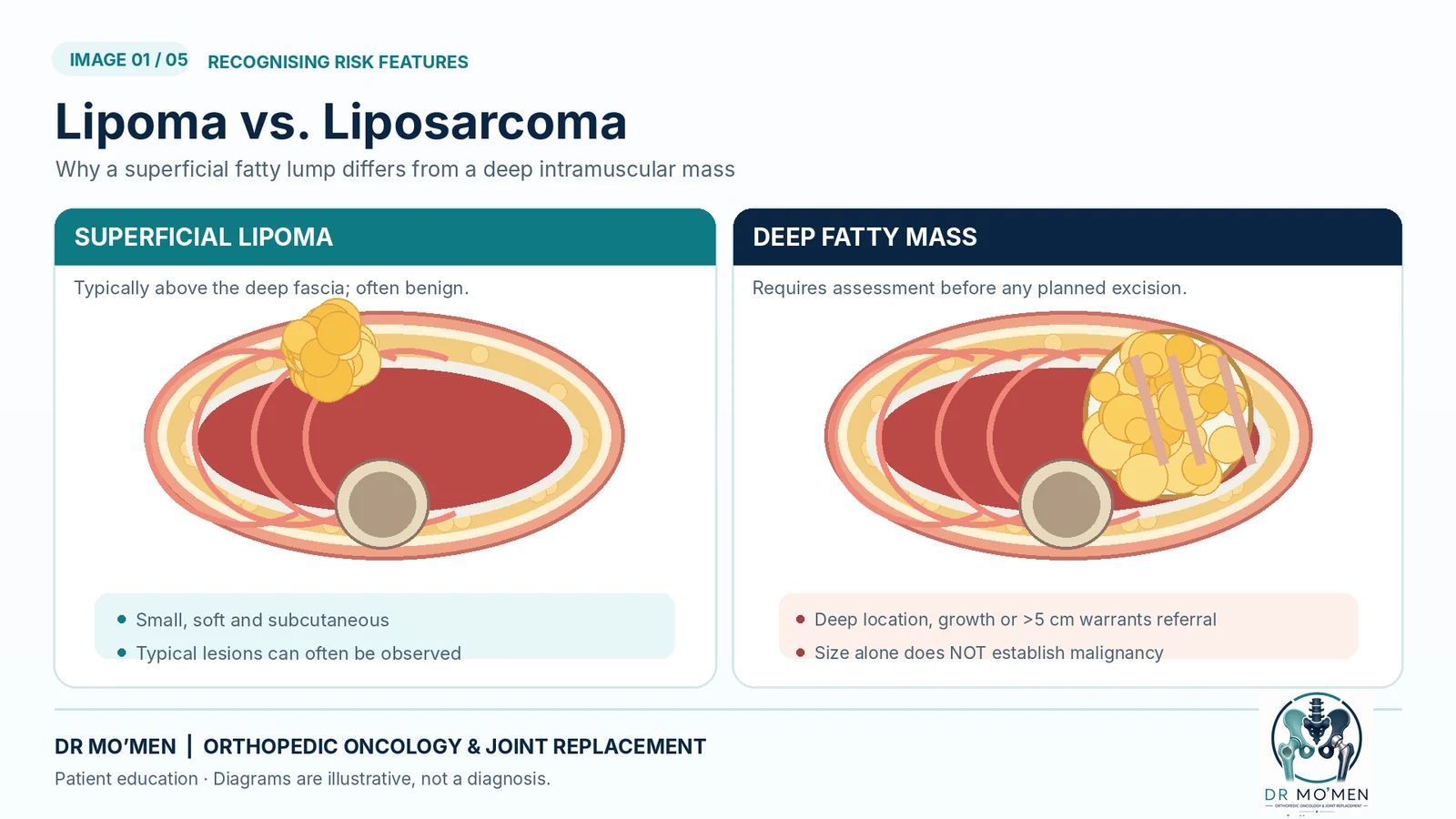 Educational diagram comparing a superficial lipoma with a deep fatty soft-tissue mass; not a patient image.