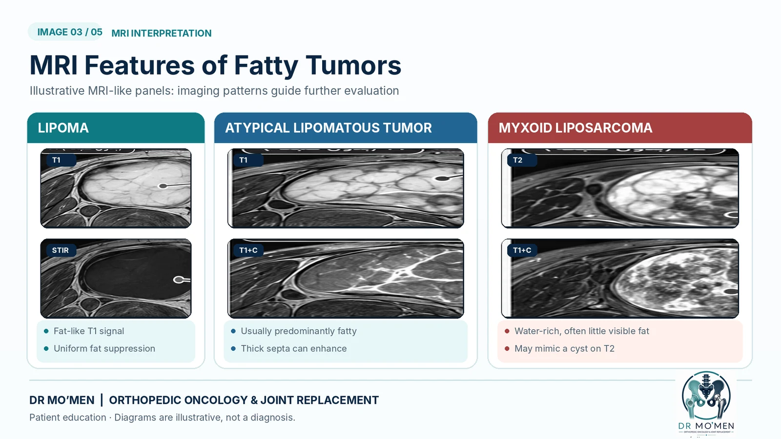 AI-generated MRI-style educational illustration of fatty masses, not an actual MRI scan.