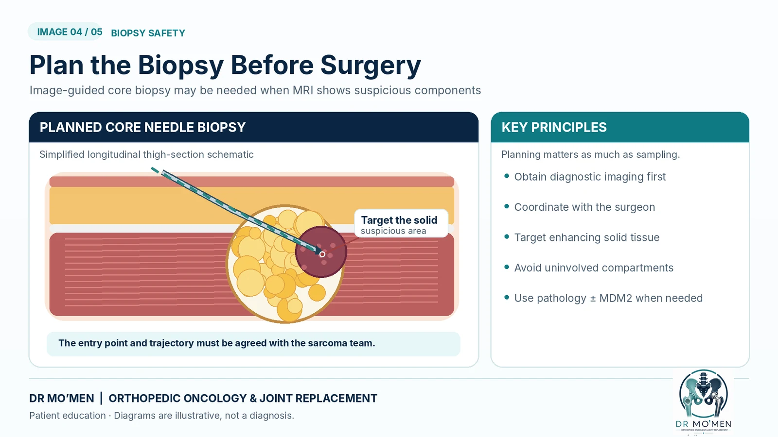 Educational diagram of image-guided core needle biopsy planning for a deep fatty mass.