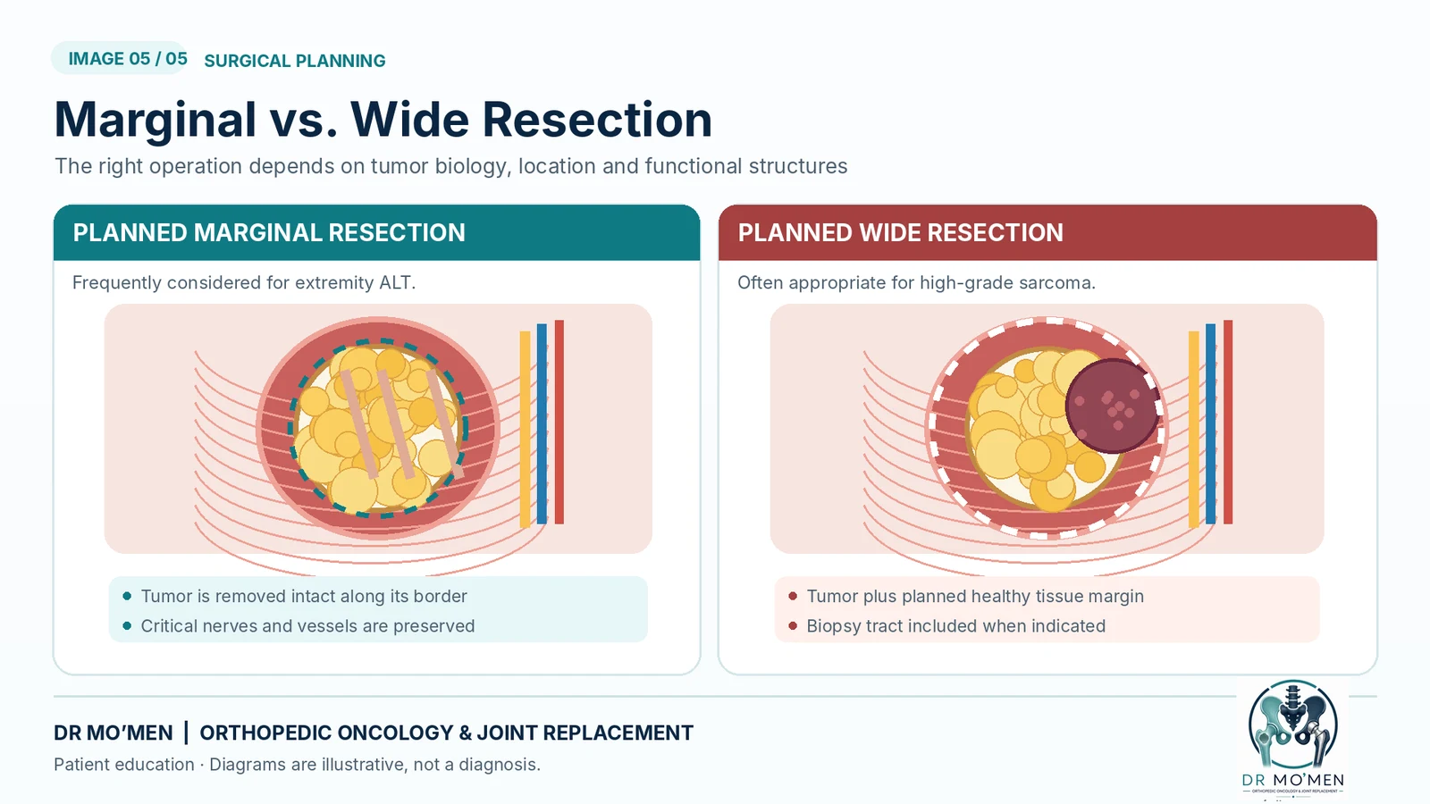 Conceptual comparison of planned marginal versus wide excision for different lipomatous tumors.
