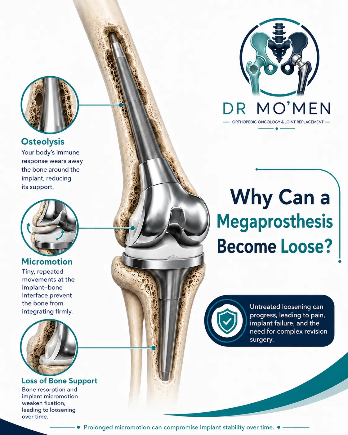 Osteolysis and loss of fixation around a megaprosthesis stem