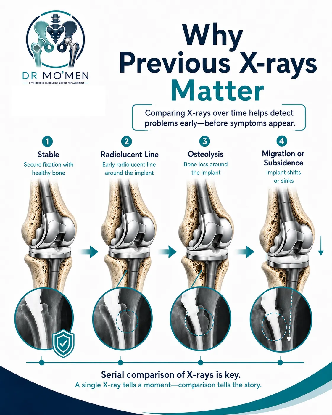 Progressive radiographic signs of megaprosthesis aseptic loosening on serial follow-up