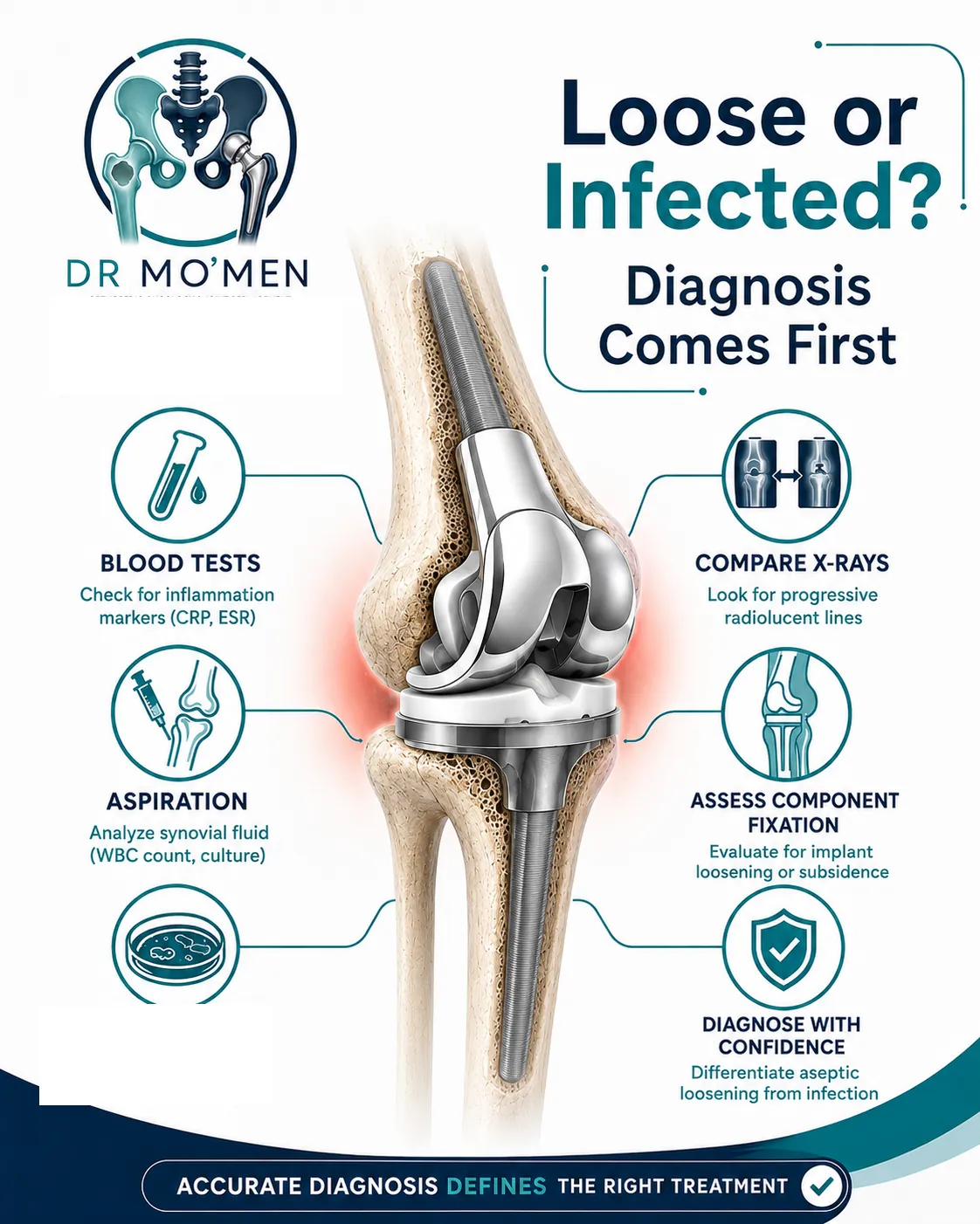 Diagnostic evaluation to distinguish aseptic loosening from megaprosthesis infection
