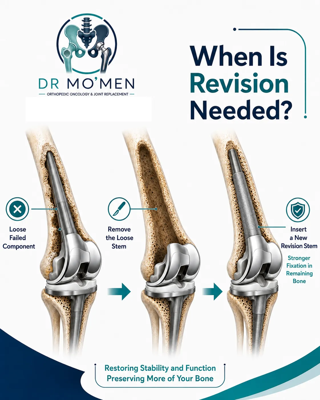Revision of a loose tumor megaprosthesis stem using fixation in remaining healthy bone