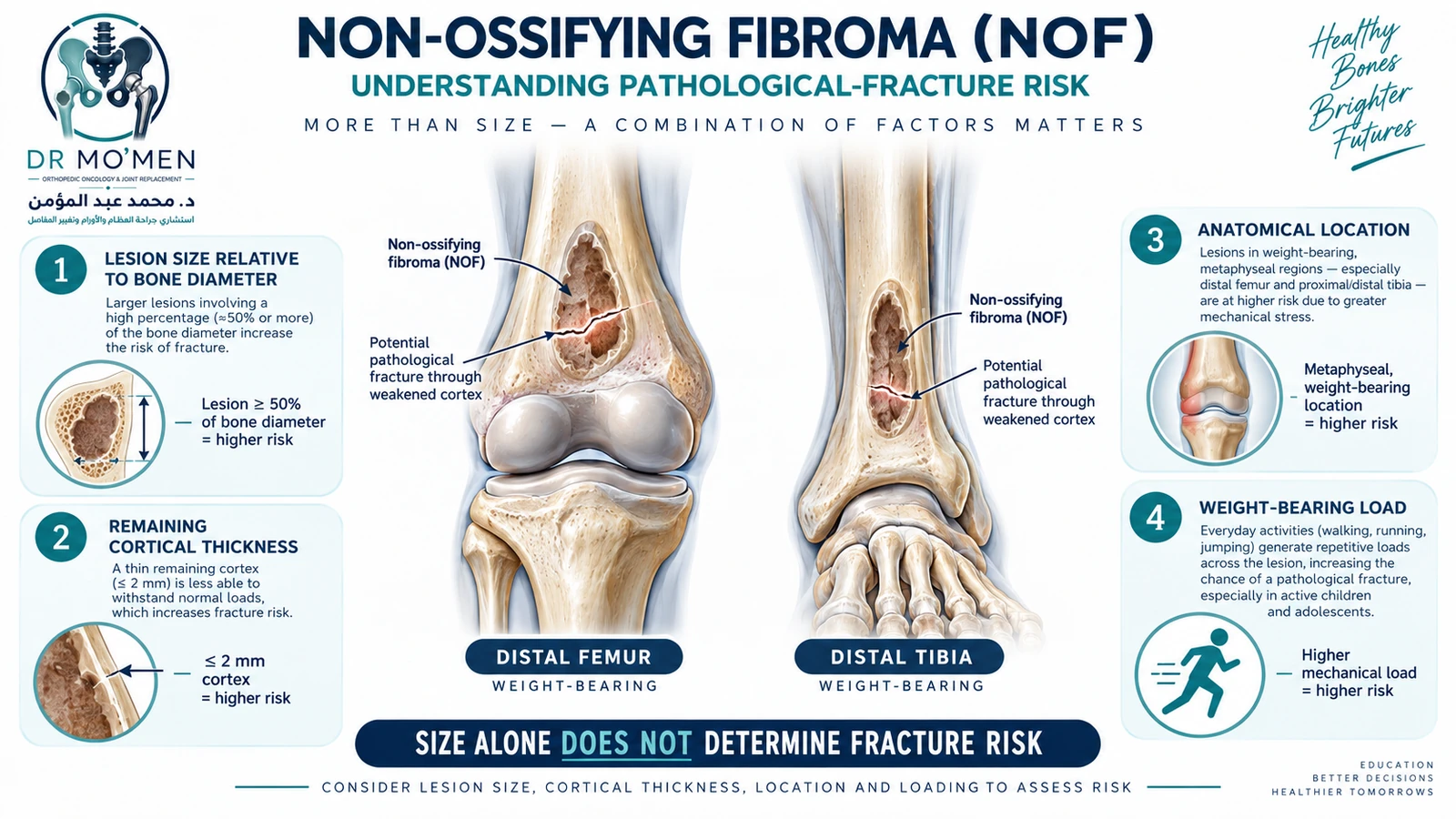 Pathological-fracture risk depends on more than lesion size. Medical illustration explaining that fracture risk from a non-ossifying fibroma depends on lesion size, location, cortical thinning and mechanical loading.