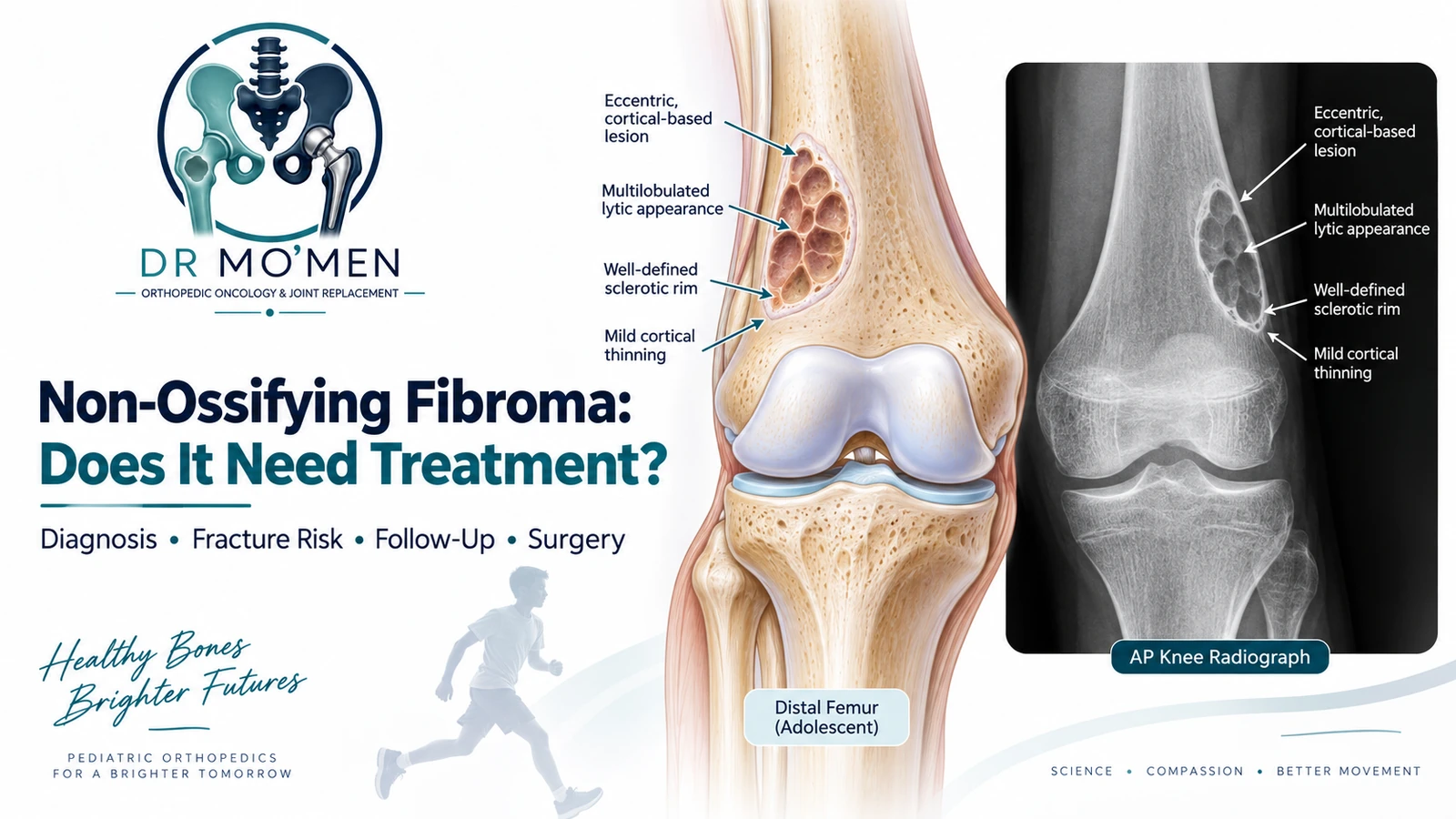 Non-Ossifying Fibroma: Does It Need Treatment? Scientifically accurate medical illustration showing a typical non-ossifying fibroma in the distal femur with an eccentric cortical-based lytic lesion and sclerotic border.