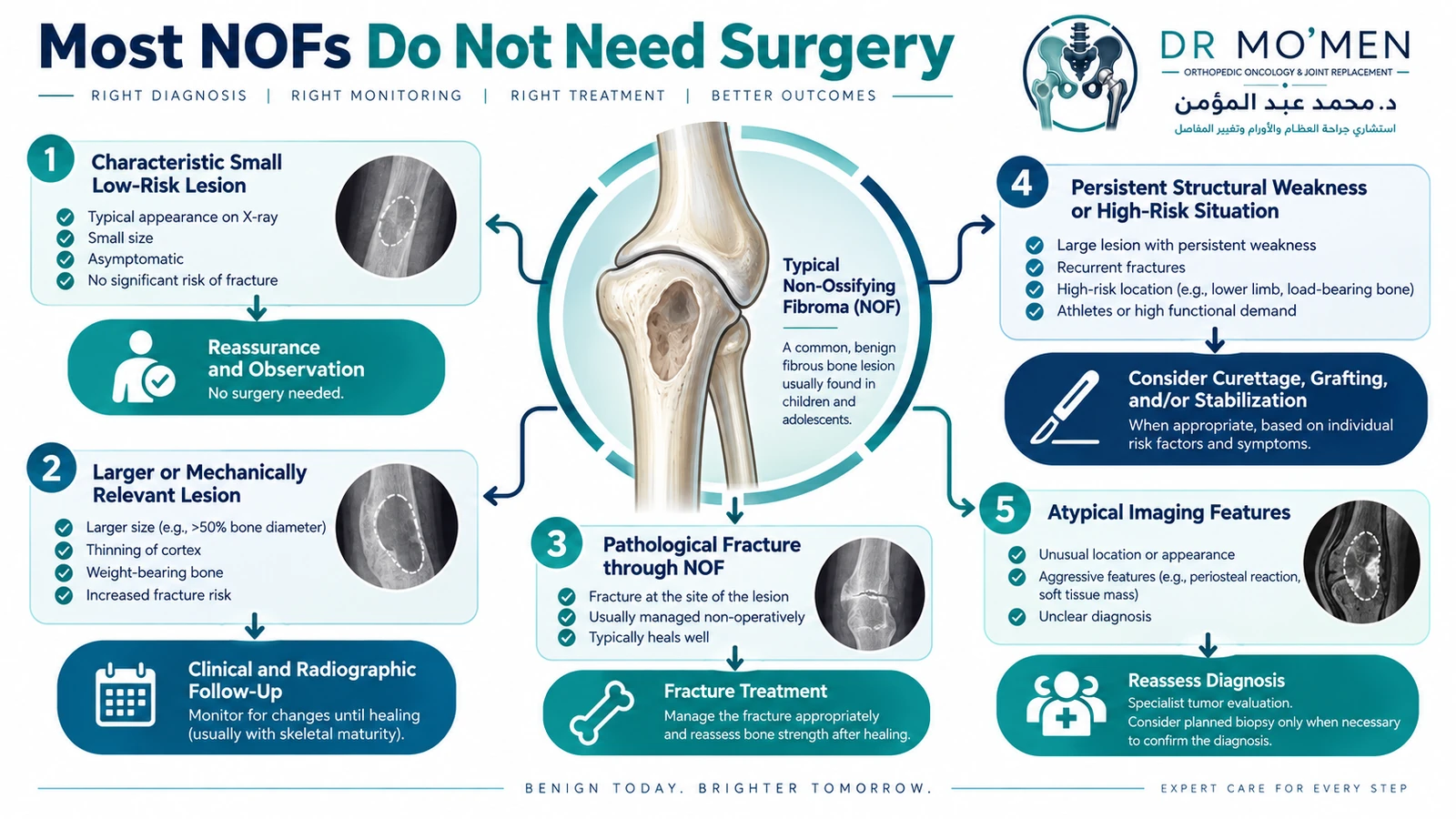 Most NOFs do not need surgery; treatment is individualized. Decision infographic showing observation for typical low-risk non-ossifying fibromas and specialist assessment for large lesions, pathological fractures or diagnostic uncertainty.