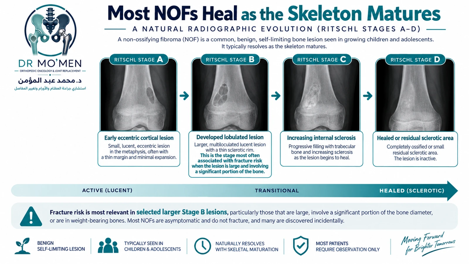 Natural radiographic evolution of NOF through the Ritschl stages. Medical infographic showing the natural progression of a non-ossifying fibroma from a lytic lesion toward increasing sclerosis and healing.