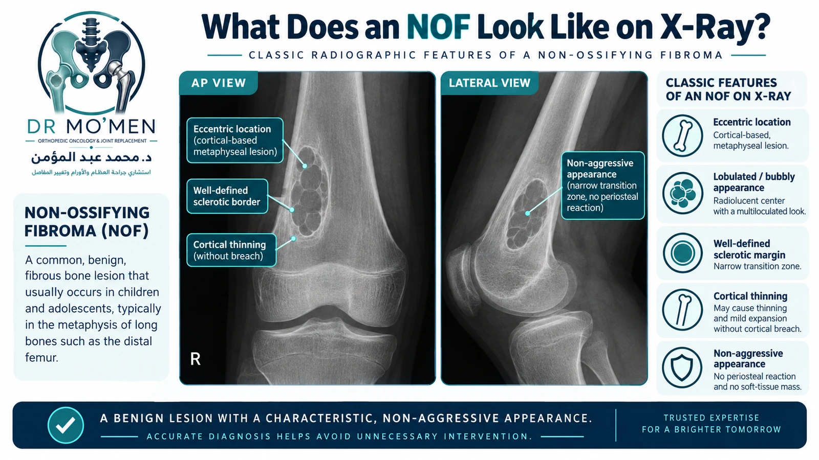 Classic radiographic features of a non-ossifying fibroma. Radiology infographic showing the typical eccentric metaphyseal appearance of a non-ossifying fibroma with a lobulated lytic lesion and sclerotic rim.