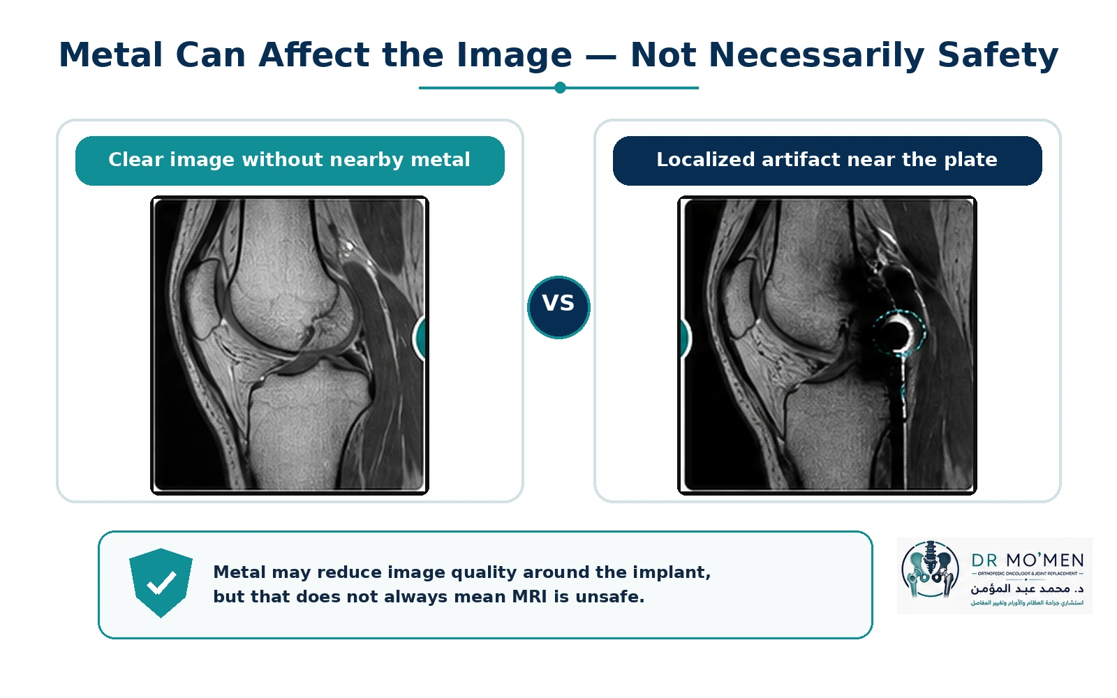 Educational comparison showing localized MRI artifact near an orthopedic plate without implying that artifact automatically equals an unsafe scan.