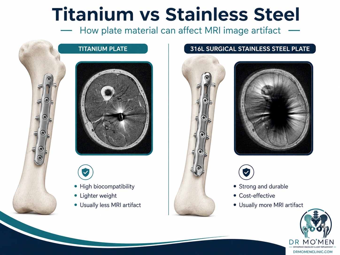Comparison of titanium and 316L surgical stainless-steel orthopedic plates with typical differences in MRI metal artifact.