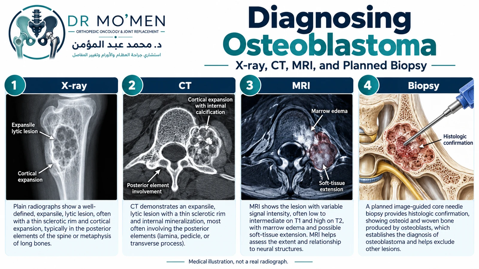 Schematic medical infographic explaining X-ray, CT, MRI, and planned biopsy in the diagnostic work-up of osteoblastoma.