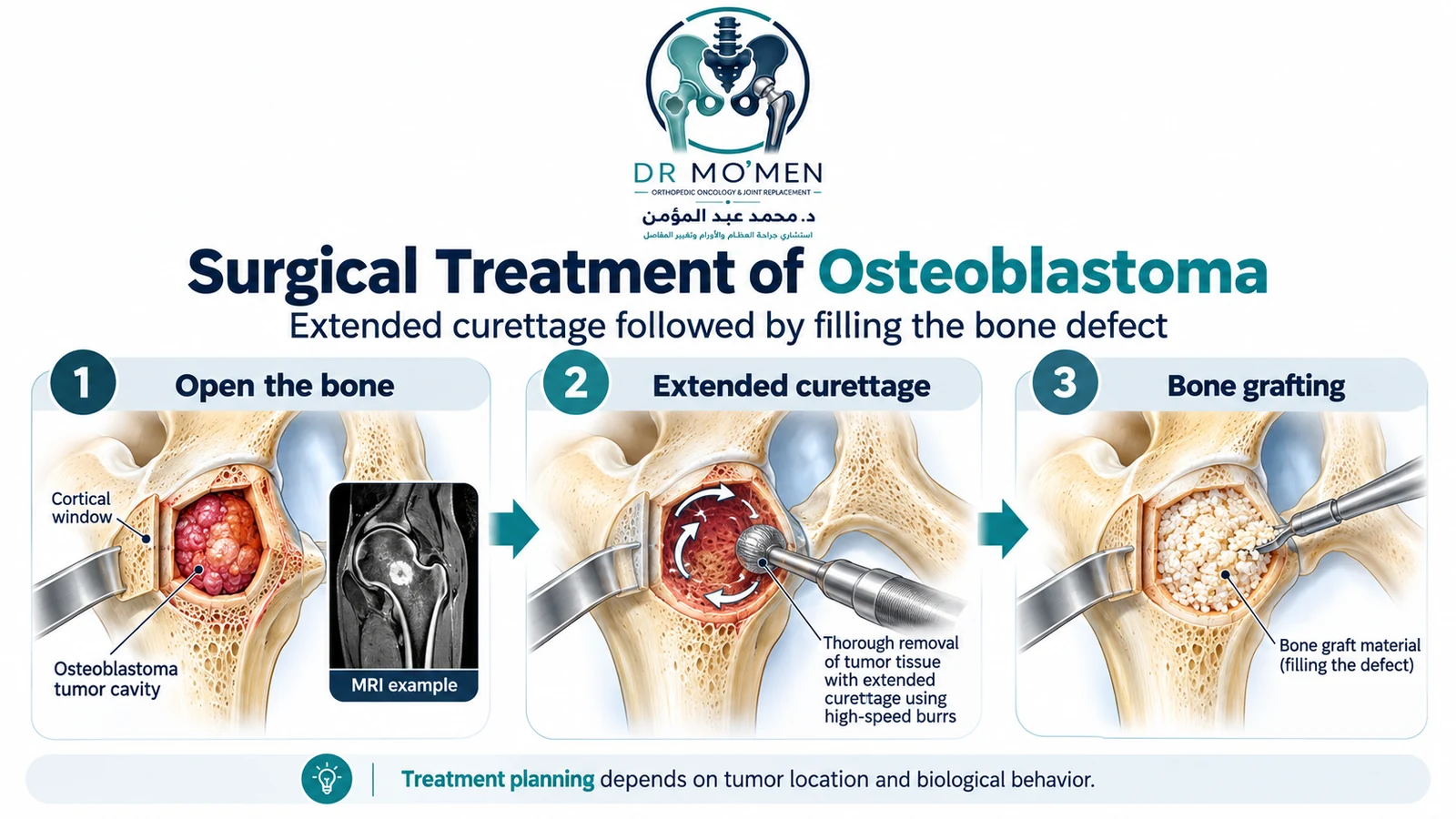 Schematic surgical illustration showing a cortical window, extended curettage with a high-speed burr, and filling of the bone defect after osteoblastoma removal.