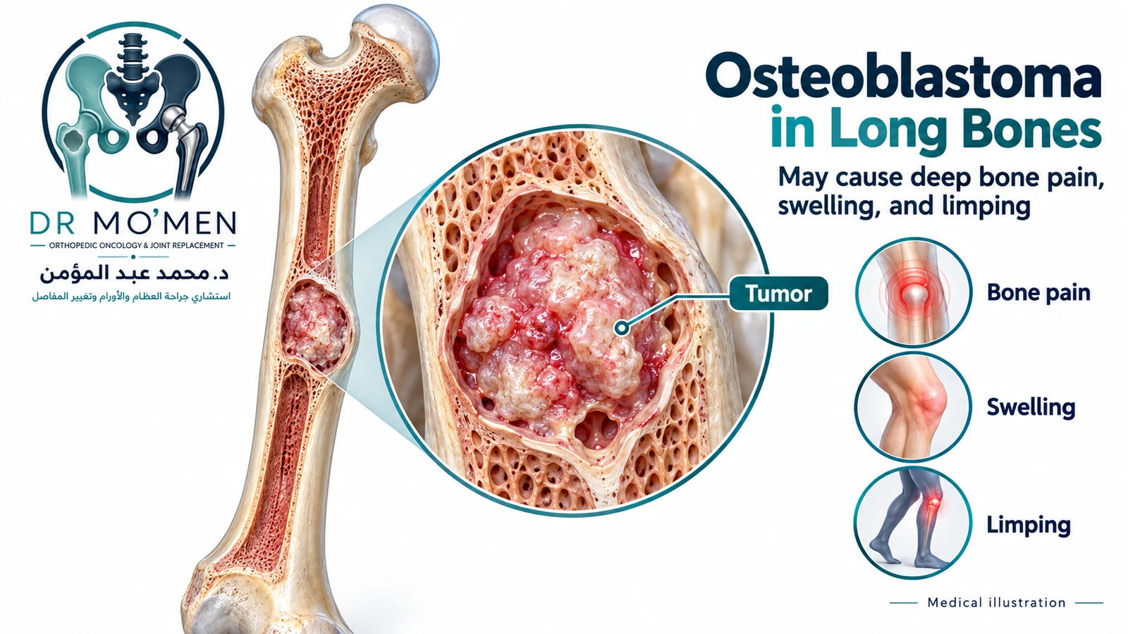 3D medical illustration of osteoblastoma in a long bone with deep bone pain, swelling, and limping as possible symptoms.