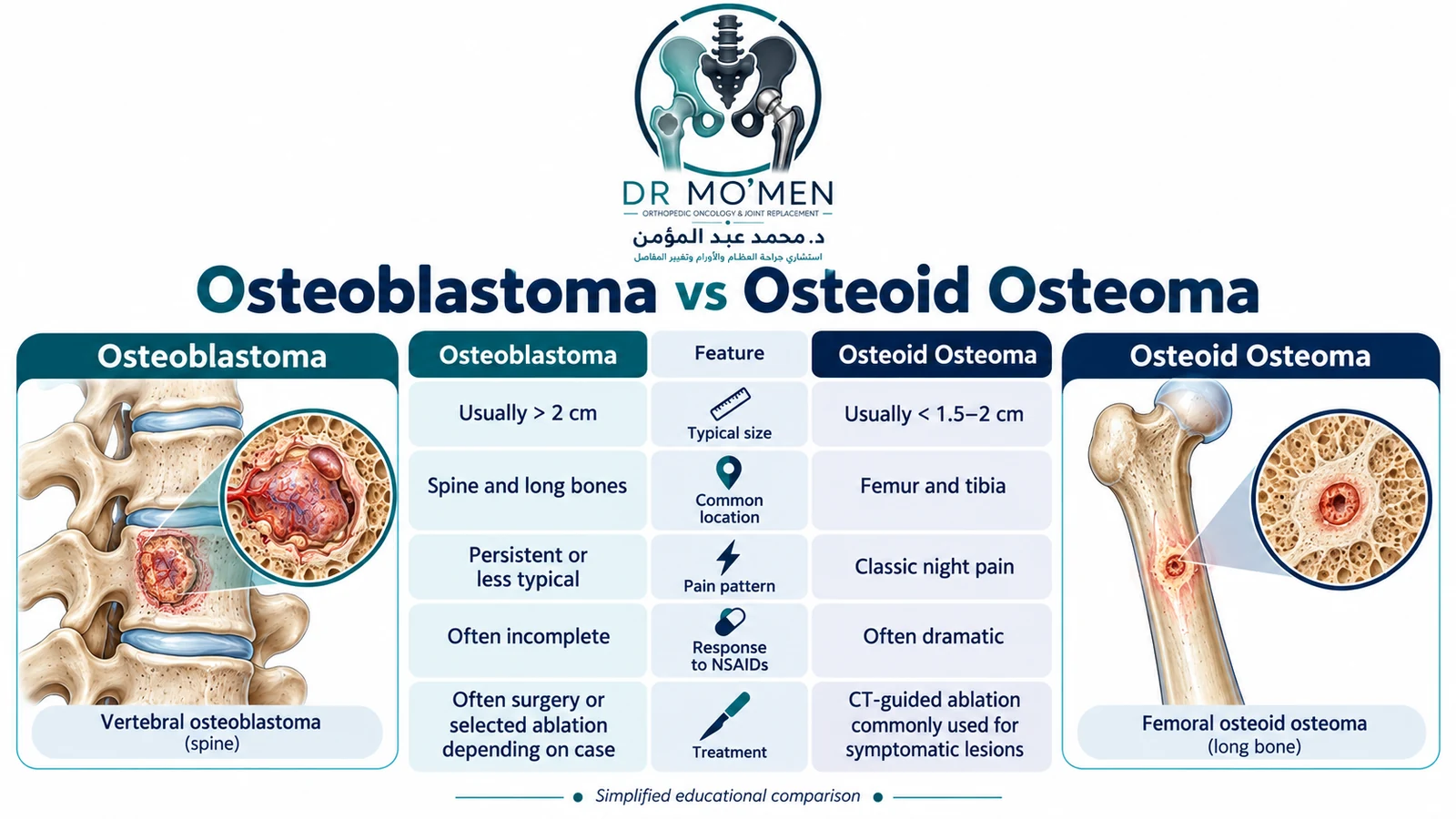 Medical infographic comparing typical size, location, pain pattern, NSAID response, and treatment of osteoblastoma versus osteoid osteoma.