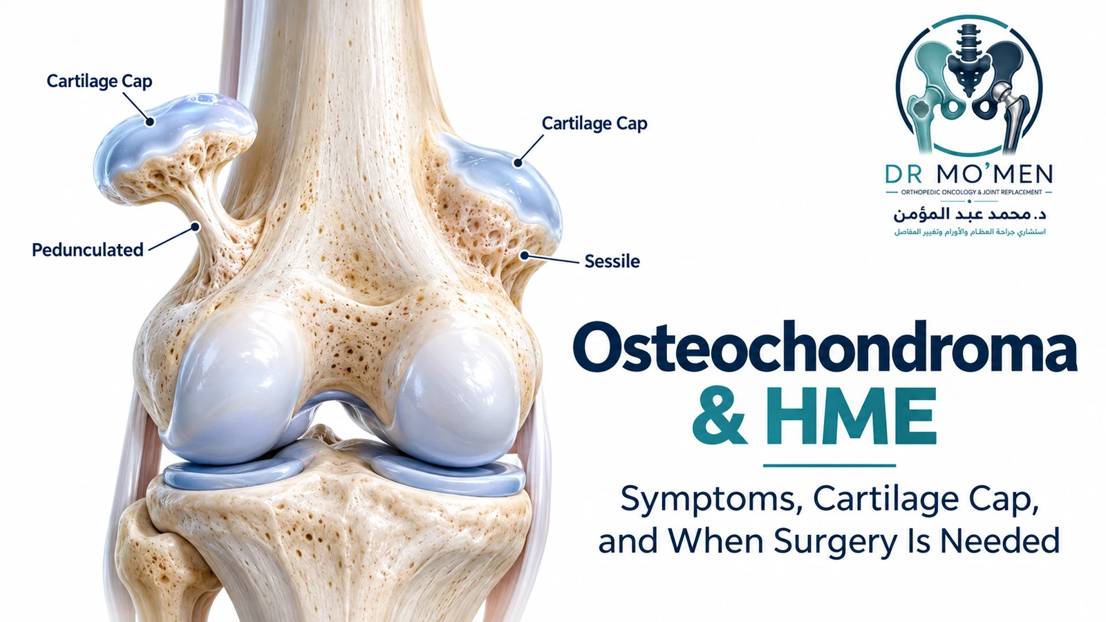 Anatomical comparison of pedunculated and sessile osteochondromas with cartilage caps.
