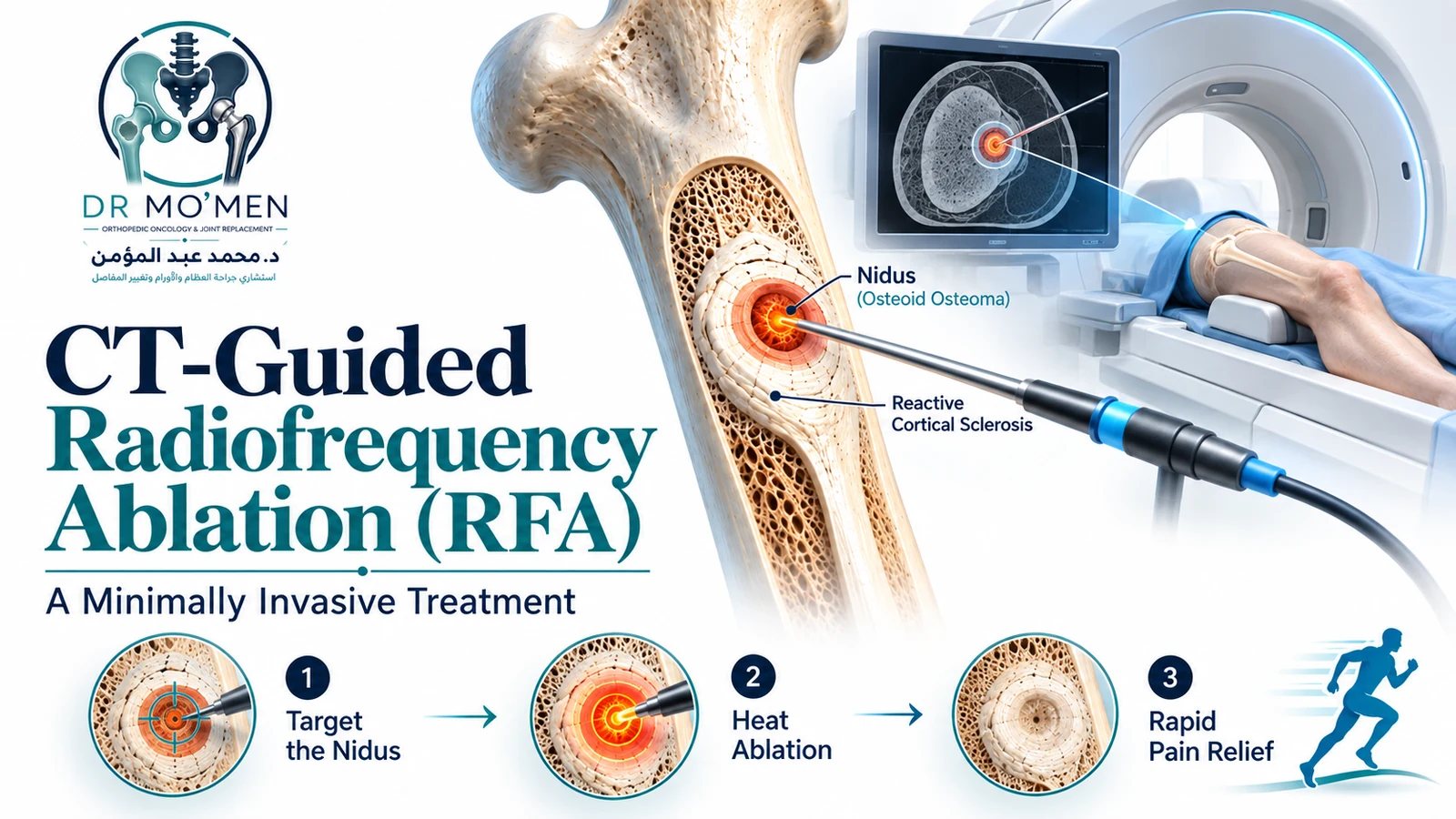 Schematic medical illustration of CT-guided radiofrequency ablation targeting the nidus of an osteoid osteoma.