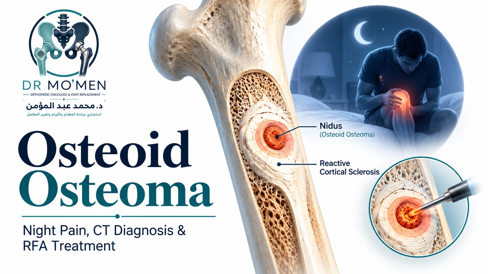 Schematic medical illustration of osteoid osteoma showing a small nidus with reactive cortical sclerosis, nocturnal pain, and image-guided ablation concept.