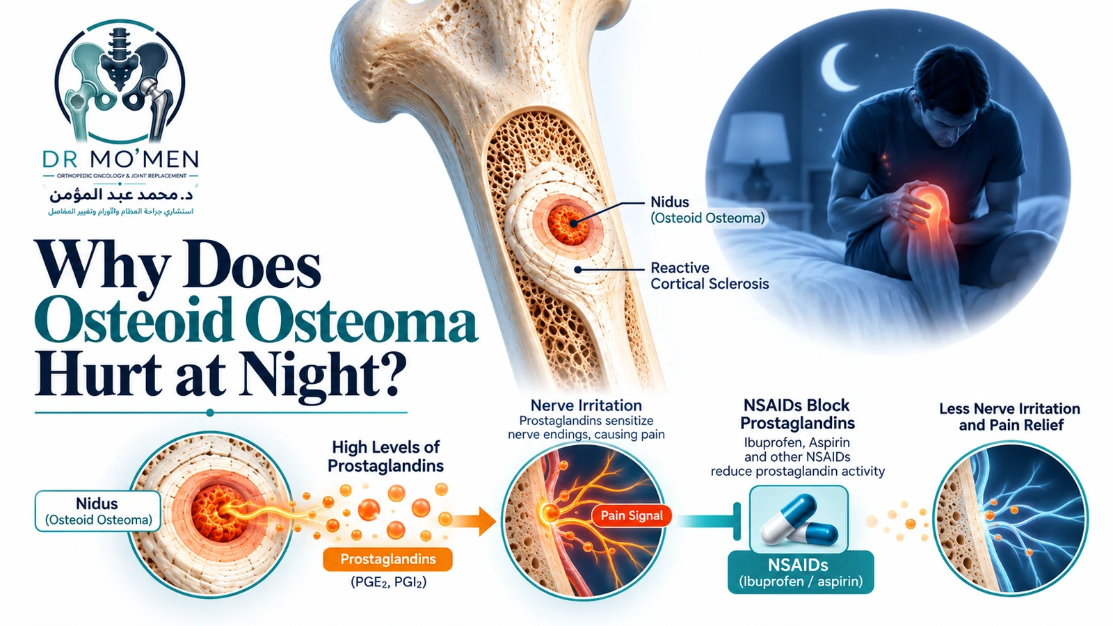 Medical infographic showing prostaglandin-driven pain in osteoid osteoma and how NSAIDs reduce prostaglandin activity.