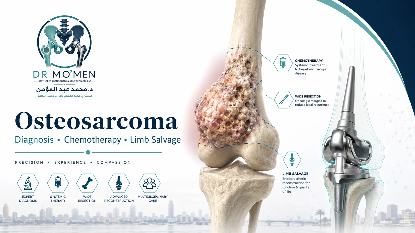 3D orthopedic oncology illustration showing osteosarcoma of the distal femur with limb-salvage reconstruction planning