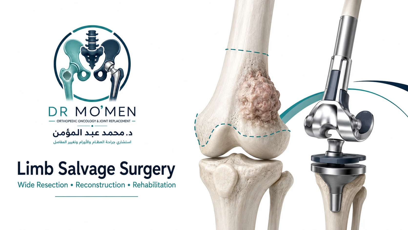 3D medical illustration showing wide resection of distal femoral osteosarcoma followed by megaprosthetic limb-salvage reconstruction