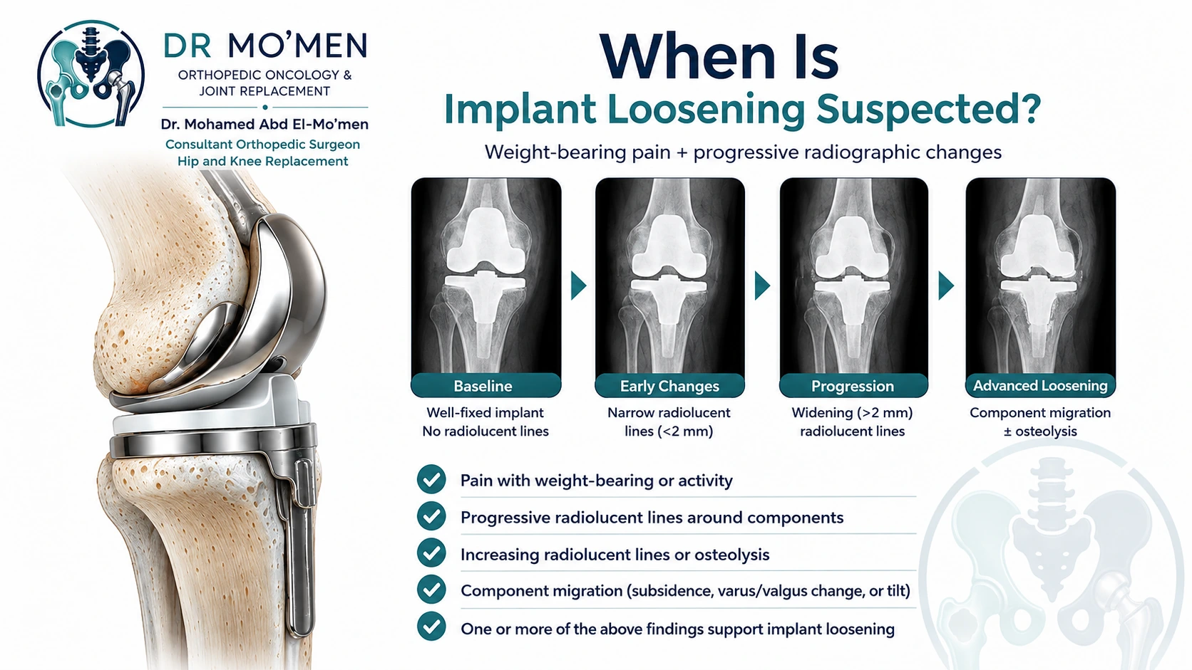Medical infographic showing suspicion of knee implant loosening with weight-bearing pain and progressive radiographic changes.