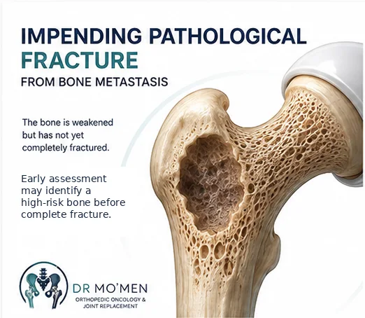 Femoral bone metastasis weakening the cortex before a complete pathological fracture