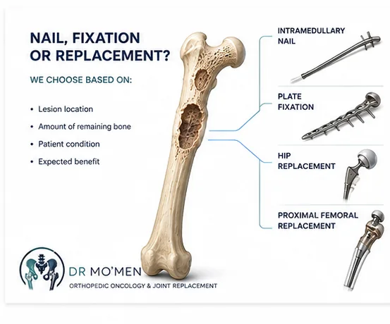 Reconstruction options for metastatic femoral lesions including nail fixation plate fixation arthroplasty and proximal femoral replacement
