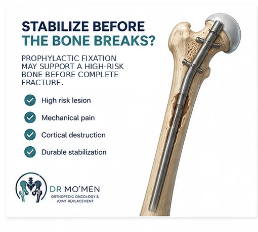 Prophylactic stabilization of a high-risk femoral bone metastasis before complete fracture