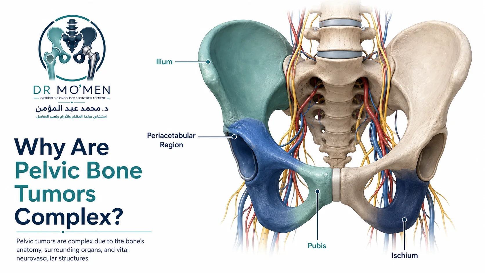 Medical illustration showing important pelvic bone tumor locations including ilium, acetabulum, pubis and ischium