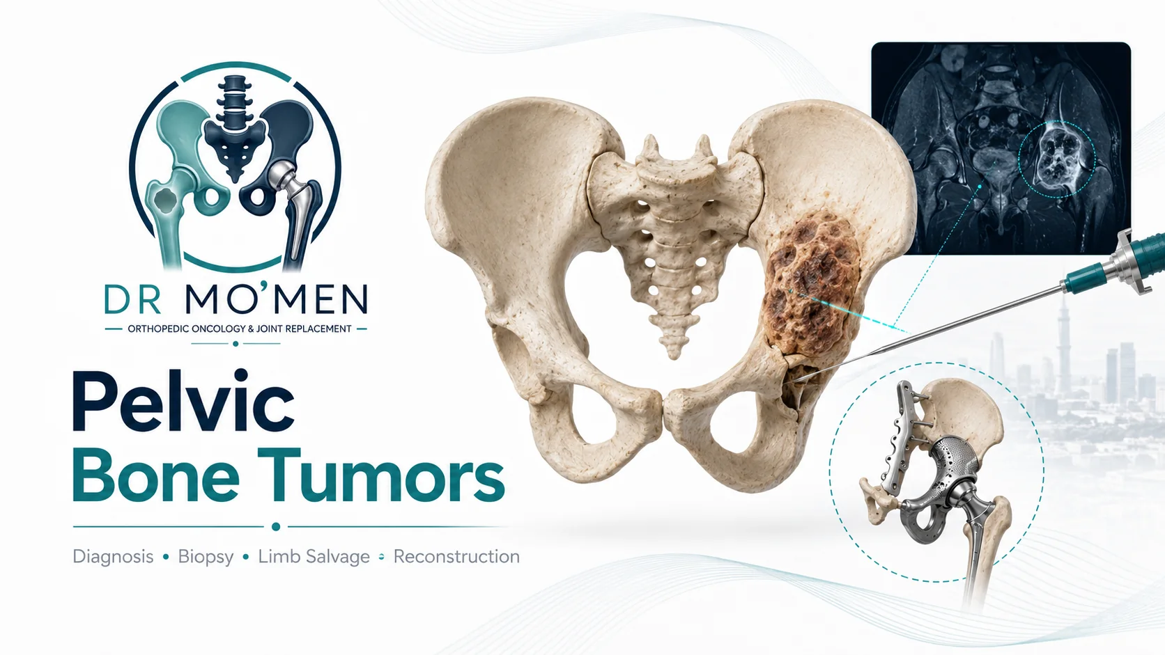 3D orthopedic oncology illustration showing a pelvic bone tumor with MRI, biopsy and limb-salvage reconstruction concepts