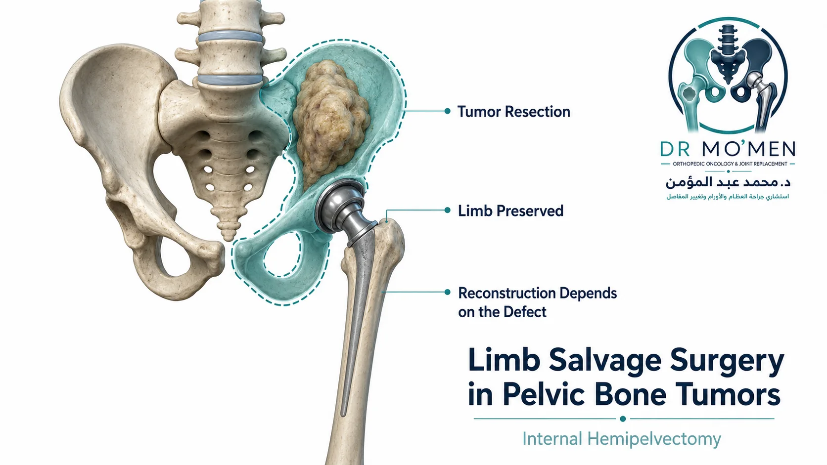 3D orthopedic oncology illustration showing internal hemipelvectomy with preservation of the lower limb