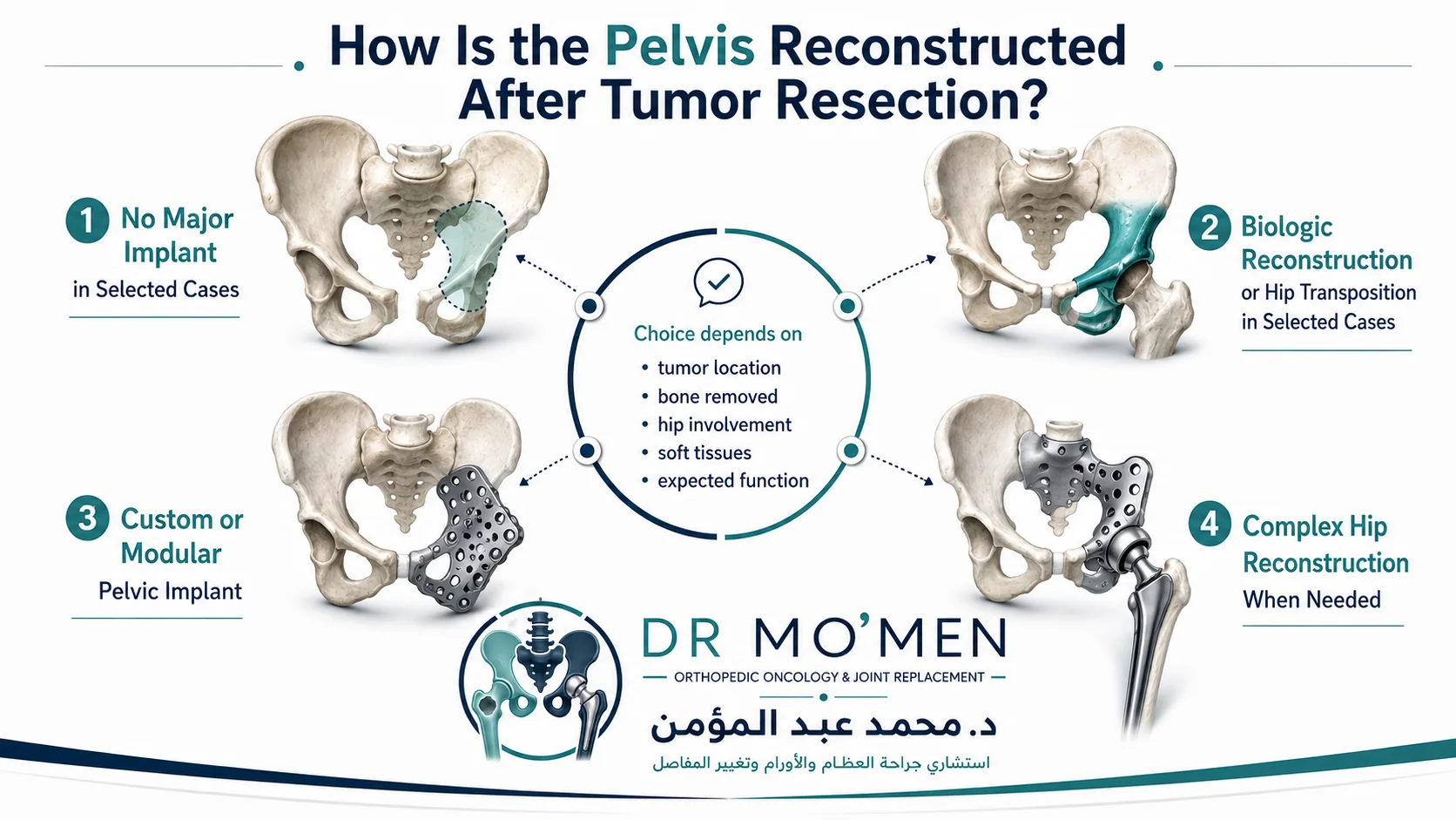 Orthopedic oncology infographic showing reconstruction options after pelvic tumor resection