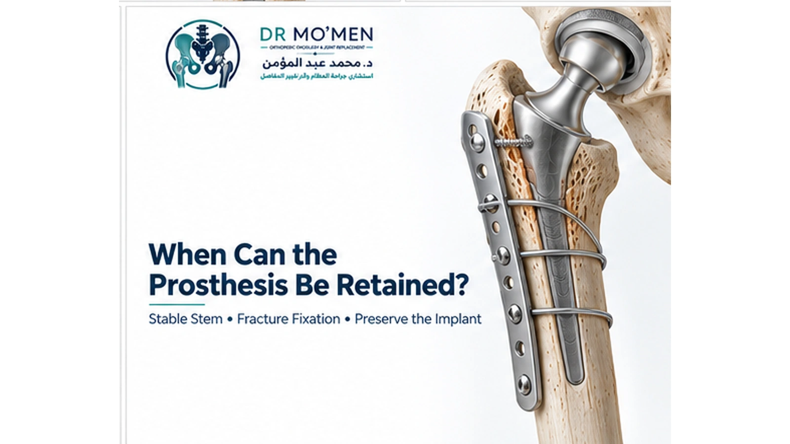 3D illustration showing plate, cables and fracture fixation around a stable hip replacement stem.
