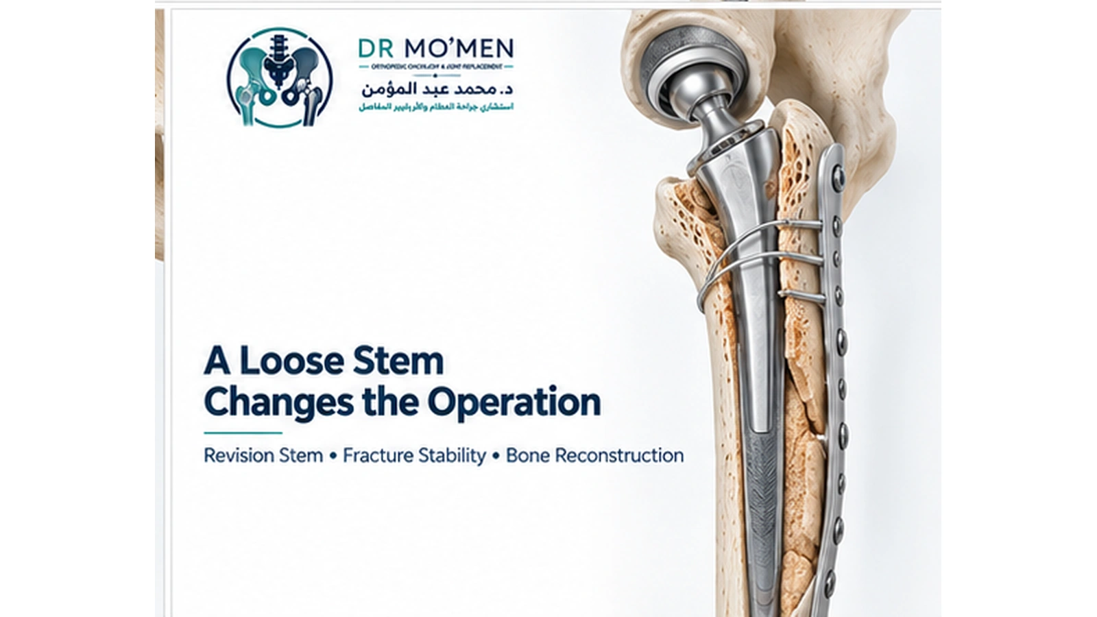 3D medical illustration showing long-stem revision hip reconstruction for a periprosthetic femoral fracture with a loose prosthesis.