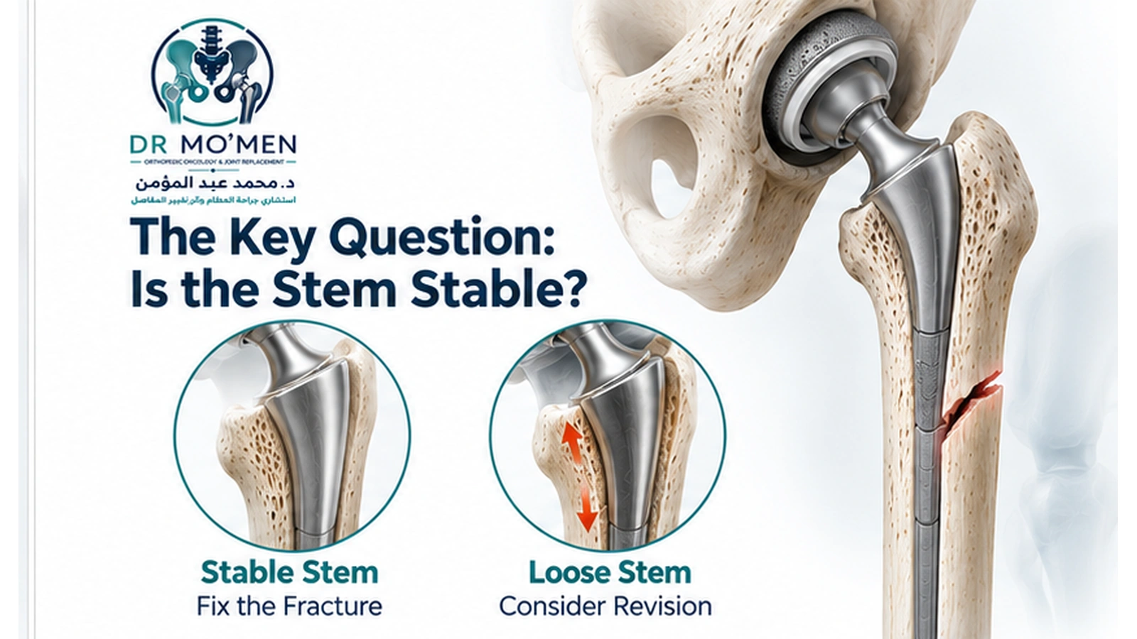 Medical illustration explaining how femoral stem stability influences treatment of a periprosthetic hip fracture.