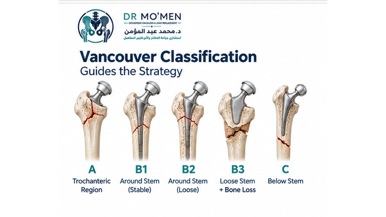 Medical infographic explaining Vancouver B1, B2 and B3 periprosthetic femoral fractures.